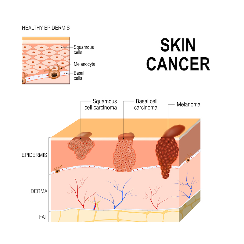 skin cancer